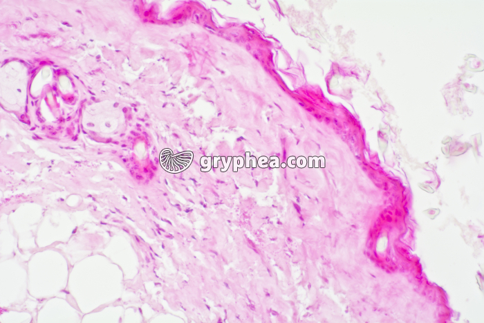 Rejet de greffe de peau x100 - gryphea.com